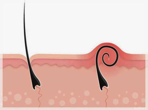 Как удалить глубоко вросший волос на лобке. Вросшие волосы в паху