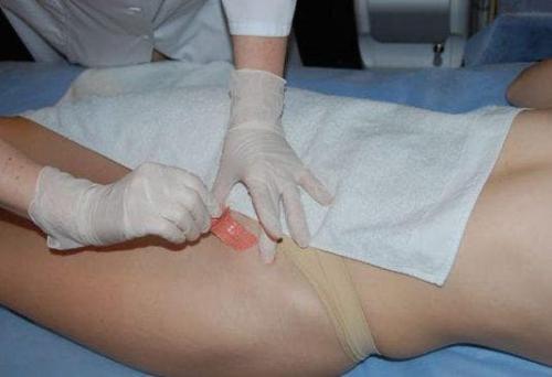 Депиляция зоны бикини дома. Выбор метода