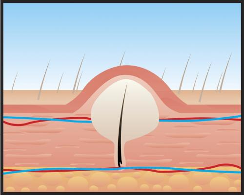 Как удалить глубоко вросший волос на лобке. Вросшие волосы в паху