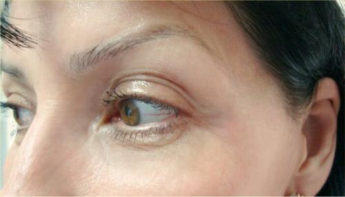 Удаление кругов под глазами лазером. Описание