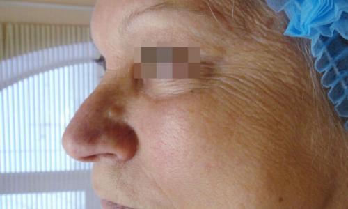 Удаление кругов под глазами лазером. Описание