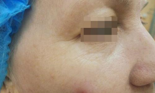 Удаление кругов под глазами лазером. Описание