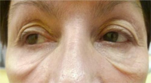 Удаление кругов под глазами лазером. Описание