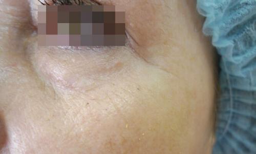 Удаление кругов под глазами лазером. Описание