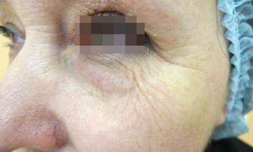 Удаление кругов под глазами лазером. Описание