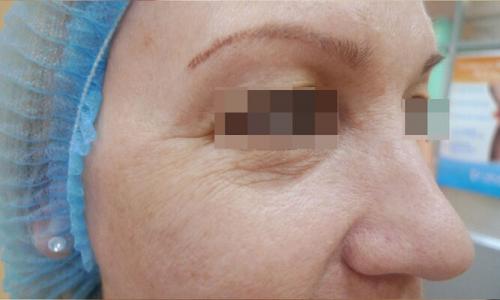 Удаление кругов под глазами лазером. Описание