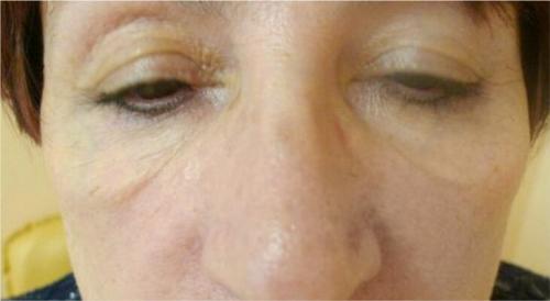 Удаление кругов под глазами лазером. Описание