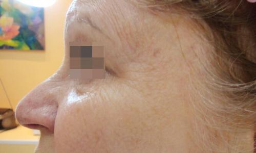 Удаление кругов под глазами лазером. Описание