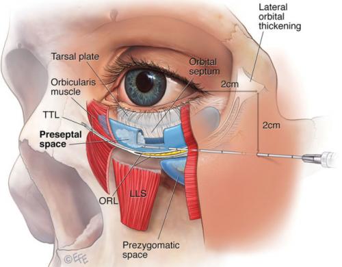 Темные круги под глазами, какие анализы сдать. Как убрать круги филлерами.