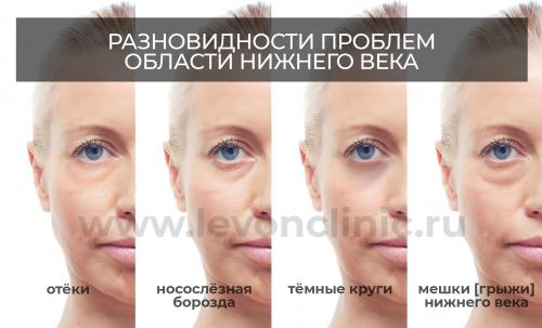 Как убрать синие круги под глазами. Болезни внутренних органов 06