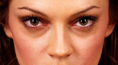 Убрать синяки и круги под глазами. Секреты быстрой маскировки: как убрать синяки под глазами за 5 минут? 12