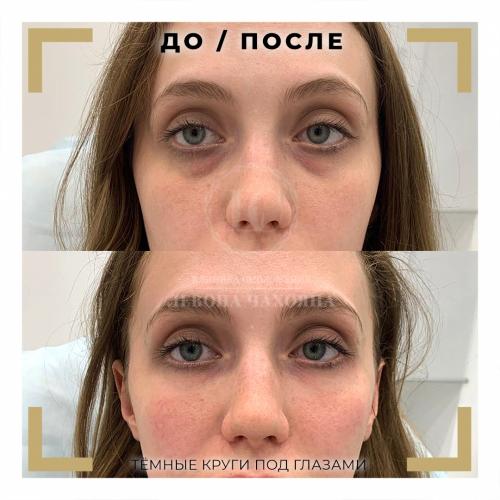 Тонкая кожа под глазами видны вены. Разбираемся в причинах проблемы.