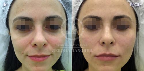 Тонкая кожа под глазами видны вены. Разбираемся в причинах проблемы.