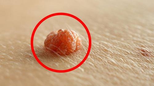 Как отличить родинку от папилломы. Отличие родинки от папилломы