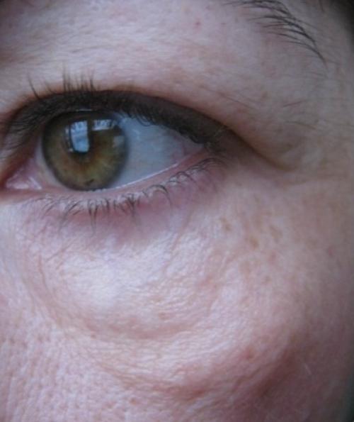 Как убрать мешки под глазами без операции. Какие процедуры можно называть безоперационной пластикой век? 08 Как убрать мешки под глазами без операции. Какие процедуры можно называть безоперационной пластикой век? 08