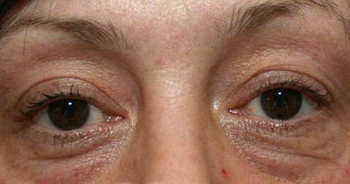 Как убрать мешки под глазами без операции. Какие процедуры можно называть безоперационной пластикой век? 07 Как убрать мешки под глазами без операции. Какие процедуры можно называть безоперационной пластикой век? 07