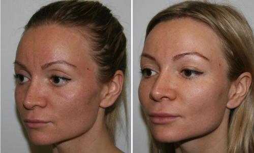 Как убрать мешки под глазами без операции. Какие процедуры можно называть безоперационной пластикой век? 11 Как убрать мешки под глазами без операции. Какие процедуры можно называть безоперационной пластикой век? 11