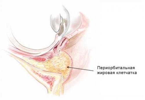 Как убрать мешки под глазами без операции. Какие процедуры можно называть безоперационной пластикой век? 04 Как убрать мешки под глазами без операции. Какие процедуры можно называть безоперационной пластикой век? 04