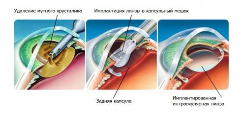Послеоперационный период после удаления катаракты. Какие ограничения бывают во время реабилитации после удаления катаракты 02 Послеоперационный период после удаления катаракты. Какие ограничения бывают во время реабилитации после удаления катаракты 02