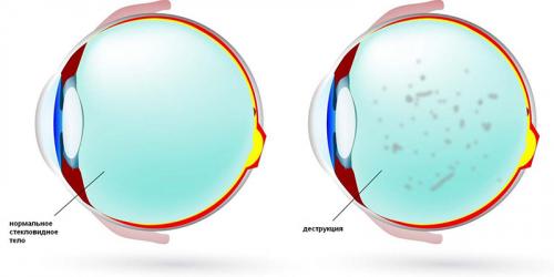 Плавающие мушки перед глазами. Перед глазами плавают, как будто черные ниточки - что это? 05
