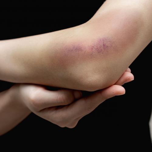 Как убрать отеки под глазами. Неправильное питание 01 Как убрать отеки под глазами. Неправильное питание 01