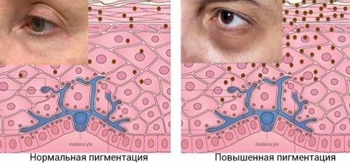 Убрать темные круги вокруг глаз. Почему под глазами появляются темные круги? 03 Убрать темные круги вокруг глаз. Почему под глазами появляются темные круги? 03