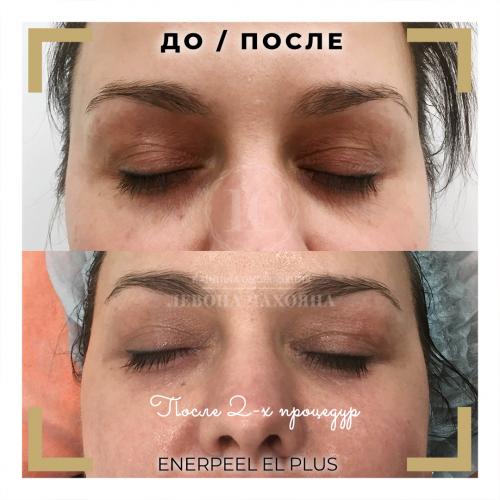 Средство от темных кругов под глазами в домашних условиях. Реально работающие способы убрать тёмные круги.