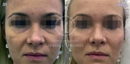 Как убрать темные круги под глазами народными средствами. Разбираемся в причинах проблемы.