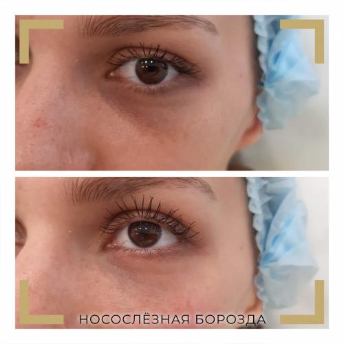 Как избавиться от синяков под глазами навсегда в домашних условиях. Разбираемся в причинах проблемы.