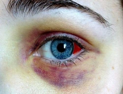 Как быстро избавиться от синяков под глазами. Домашние тактики борьбы со стойкими синяками под глазами 02