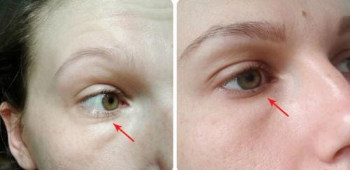 Как пользоваться патчами для глаз. Виды патчей для глаз 14