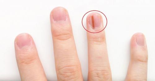 Как укрепить ногти после гель лака. Что такое ониходистрофия