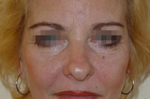 Хронические синяки и темные круги под глазами. Вопрос: Малярные мешки.