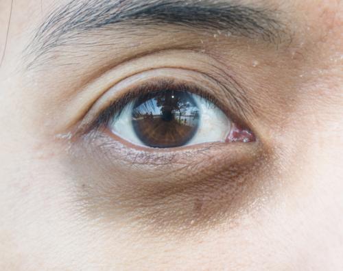 Темные уголки глаз, как избавиться. Давайте взглянем на анатомическое строение области глаз.