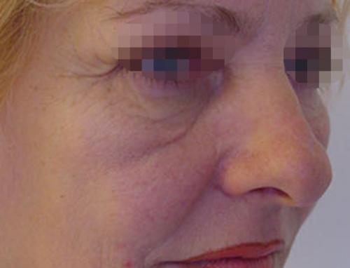 Хронические синяки и темные круги под глазами. Вопрос: Малярные мешки.