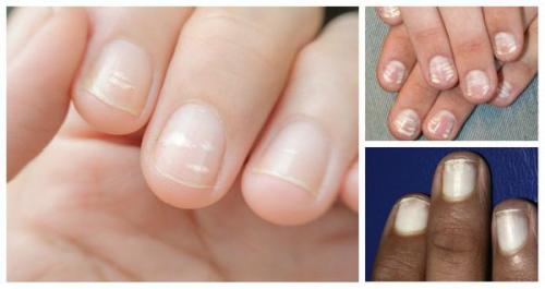 12 проблем с ногтями. Болезни ногтей 06 12 проблем с ногтями. Болезни ногтей 06