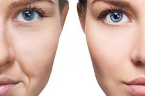Как убрать круги под глазами косметологическим путем. Как не допустить появления темных кругов 03