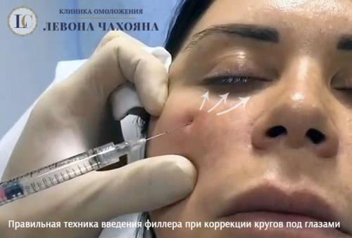 Синяки под глазами до и после. Какие препараты от кругов (синяков) под глазами можно использовать?