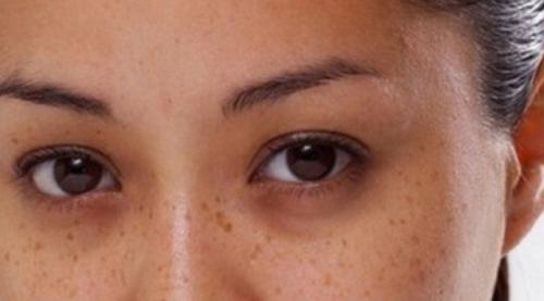 Убрать синяки под глазами. Чем мазать синяк 02 Убрать синяки под глазами. Чем мазать синяк 02