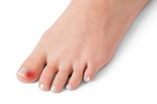 Как правильно подстричь вросший ноготь на большом пальце. Врастает ноготь на ноге - что делать? 01