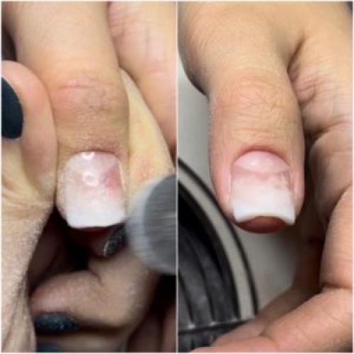 Что делать, если ногтевая пластина неровная