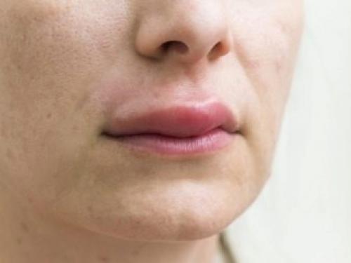 Как мастеру и клиенту избавиться от аллергии на гель-лак. Аллергия у мастера маникюра: профилактика и лечение 12