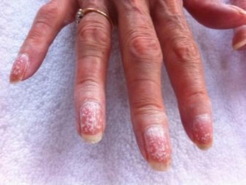 Как мастеру и клиенту избавиться от аллергии на гель-лак. Аллергия у мастера маникюра: профилактика и лечение 06