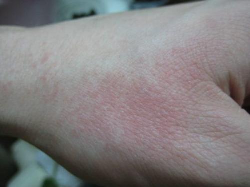 Аллергия на гель-лак чем заменить. Причины возникновения аллергии