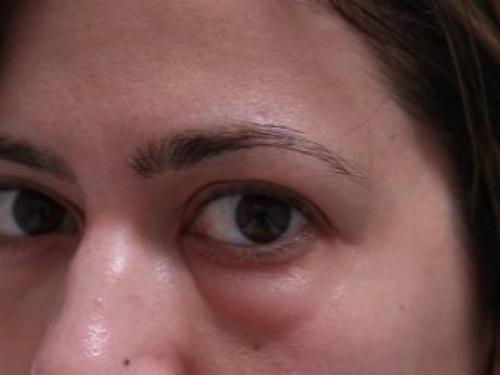 Как мастеру и клиенту избавиться от аллергии на гель-лак. Аллергия у мастера маникюра: профилактика и лечение 10