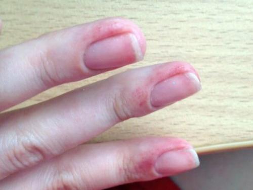 Аллергия на гель-лак чем заменить. Причины возникновения аллергии