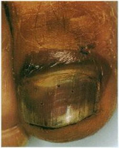 Ногти стали бугристыми: основные причины и способы лечения 03