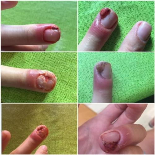 Осложнения маникюра и педикюра. Опасности маникюра и педикюра 01