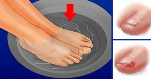 Причины и лечение онихолизиса. Онихолизис – причины возникновения 04