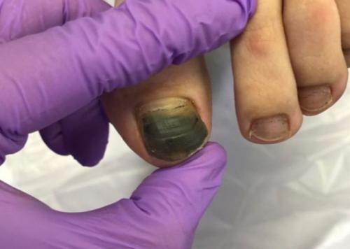 Как лечить онихолизис на руках в домашних условиях. Немного о заболевании